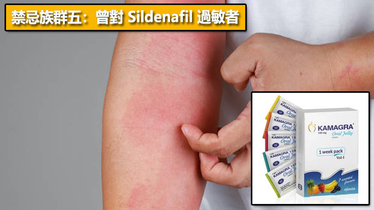 禁忌族群五：曾對 Sildenafil 過敏者